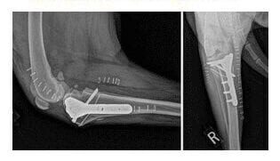 X-ray of elbow with metal implants.