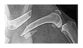 X-ray of a broken bone fracture.